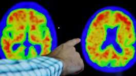 Alzheimer's disease on PET scans